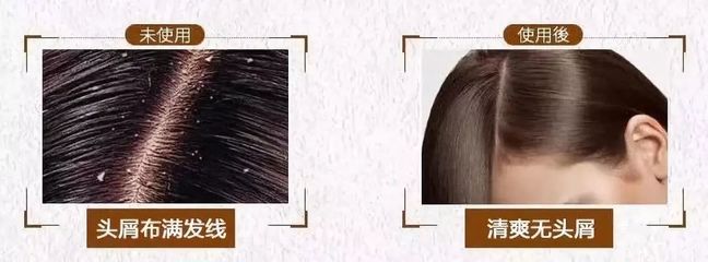 告别脱发、头皮屑与头发稀少的烦恼，重塑乌黑浓密的秀发